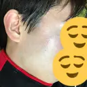 美容点滴・美容注射（美肌） / 美肌レーザー / フラクショナルレーザー（毛穴・ニキビ跡） 飯田橋駅前さくら坂クリニック DAY 6 サムネイル用