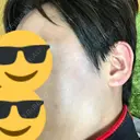 美容点滴・美容注射（美肌） / 美肌レーザー / フラクショナルレーザー（毛穴・ニキビ跡） 飯田橋駅前さくら坂クリニック DAY 6 サムネイル用