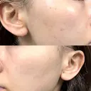 ピーリング（ニキビ・毛穴） / ルメッカ WellnessPlus Clinic 【ウェルネスプラスクリニック】 AFTER サムネイル用