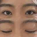 二重埋没 WOM CLINIC GINZA （ワム クリニック ギンザ） DAY 16 サムネイル用