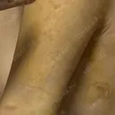 脂肪吸引（顔） / 脂肪吸引（二の腕） / 脂肪吸引（脚） / 脂肪吸引（お腹） / 脂肪吸引（お尻） / 脂肪吸引（腰） / 脂肪吸引（背中） / 脂肪吸引（肩） ヴェルトラクリニック 新宿院 DAY 5 サムネイル用