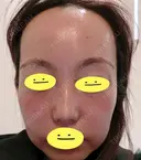 水光注射（ハリ・美肌） / 肌育注射（ジュベルックなど） Chloe Cheongdam Clinic （クロエチョンダムクリニック） DAY 0 サムネイル用