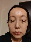 水光注射（ハリ・美肌） / 肌育注射（ジュベルックなど） Chloe Cheongdam Clinic （クロエチョンダムクリニック） DAY 1 サムネイル用