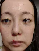 水光注射（ハリ・美肌） / 肌育注射（ジュベルックなど） Chloe Cheongdam Clinic （クロエチョンダムクリニック） DAY 2 サムネイル用