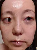 水光注射（ハリ・美肌） / 肌育注射（ジュベルックなど） Chloe Cheongdam Clinic （クロエチョンダムクリニック） DAY 3 サムネイル用