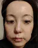 水光注射（ハリ・美肌） / 肌育注射（ジュベルックなど） Chloe Cheongdam Clinic （クロエチョンダムクリニック） AFTER サムネイル用