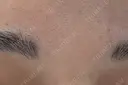 ボトックス（眉間） Leap beauty clinic DAY 3 サムネイル用