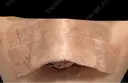 隆鼻術 / 鼻尖形成（切開） / 鼻中隔延長（切開） / 軟骨移植 / 鼻孔縁挙上 / 鼻翼基部形成（貴族手術） / 鼻柱下降・鼻唇角形成（猫手術） 4Dクリニック DAY 1 サムネイル用