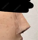 隆鼻術 / 鼻尖形成（切開） / 鼻中隔延長（切開） / 軟骨移植 / 鼻孔縁挙上 / 鼻翼基部形成（貴族手術） / 鼻柱下降・鼻唇角形成（猫手術） 4Dクリニック DAY 1 サムネイル用