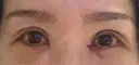 二重埋没 / 目頭切開 / 下まぶたの脂肪取り / タレ目形成・グラマラスライン（切開） 池袋麗歯科・美容皮膚科 DAY 2 サムネイル用
