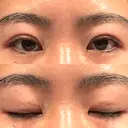 二重埋没 WOM CLINIC GINZA （ワム クリニック ギンザ） DAY 17 サムネイル用