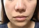 ヒアルロン酸注入（鼻翼基部） KIMI CLINIC 形成・美容外科 DAY 0 サムネイル用