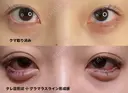 クマ治療 / 目尻切開 / タレ目形成・グラマラスライン（切開） / 脂肪注入（目の下） 藤・ナチュレ美容クリニック 銀座院 DAY 37 サムネイル用