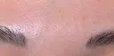 ボトックス（眉間） Leap beauty clinic DAY 4 サムネイル用