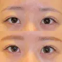 目尻切開 / タレ目形成・グラマラスライン（埋没） / 美容点滴・美容注射（美肌） LOUIS CLINIC 二子玉川院【ルイクリニック】 AFTER サムネイル用