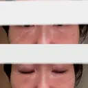 脂肪注入（目の下） 大塚美容形成外科 京都院 DAY 28 サムネイル用
