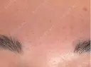 ボトックス（眉間） Leap beauty clinic DAY 5 サムネイル用