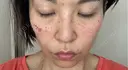 シミ取りレーザー Kaleido Clinic（カレイドクリニック） 横浜 DAY 0 サムネイル用
