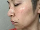 シミ取りレーザー Kaleido Clinic（カレイドクリニック） 横浜 DAY 0 サムネイル用