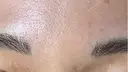 ボトックス（眉間） Leap beauty clinic DAY 6 サムネイル用