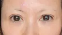 二重埋没 / その他（目元） / クマ治療 / 下まぶたの脂肪取り / 自然癒着法 / ヒアルロン酸注入（目の下） MEMOTO CLINIC 名古屋 DAY 20 サムネイル用
