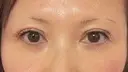 二重埋没 / その他（目元） / クマ治療 / 下まぶたの脂肪取り / 自然癒着法 / ヒアルロン酸注入（目の下） MEMOTO CLINIC 名古屋 DAY 25 サムネイル用