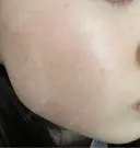 レーザートーニング（美白・肝斑） セカジソウォン医院-明洞店 AFTER サムネイル用