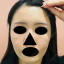 ヒアルロン酸注入（頬） / ヒアルロン酸注入（こめかみ） 仙台N美容クリニック DAY 0 サムネイル用