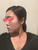 隆鼻術 / 鼻尖形成（切開） / 鼻中隔延長（切開） / 軟骨移植 / 斜鼻修正 / 鼻孔縁挙上 / 鼻翼基部形成（貴族手術） / 鼻柱下降・鼻唇角形成（猫手術） 4Dクリニック DAY 43 サムネイル用