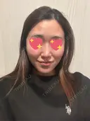 隆鼻術 / 鼻尖形成（切開） / 鼻中隔延長（切開） / 軟骨移植 / 斜鼻修正 / 鼻孔縁挙上 / 鼻翼基部形成（貴族手術） / 鼻柱下降・鼻唇角形成（猫手術） 4Dクリニック DAY 45 サムネイル用