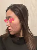 隆鼻術 / 鼻尖形成（切開） / 鼻中隔延長（切開） / 軟骨移植 / 斜鼻修正 / 鼻孔縁挙上 / 鼻翼基部形成（貴族手術） / 鼻柱下降・鼻唇角形成（猫手術） 4Dクリニック DAY 45 サムネイル用