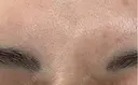 ボトックス（眉間） Leap beauty clinic DAY 7 サムネイル用