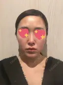 隆鼻術 / 鼻尖形成（切開） / 鼻中隔延長（切開） / 軟骨移植 / 斜鼻修正 / 鼻孔縁挙上 / 鼻翼基部形成（貴族手術） / 鼻柱下降・鼻唇角形成（猫手術） 4Dクリニック AFTER サムネイル用