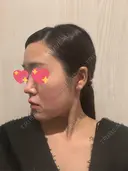 隆鼻術 / 鼻尖形成（切開） / 鼻中隔延長（切開） / 軟骨移植 / 斜鼻修正 / 鼻孔縁挙上 / 鼻翼基部形成（貴族手術） / 鼻柱下降・鼻唇角形成（猫手術） 4Dクリニック DAY 55 サムネイル用