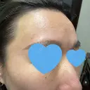 ダーマペン / PRP皮膚再生療法 / ヴァンパイアフェイシャル 筋肉・美容クリニック DAY 13 サムネイル用