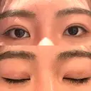 二重埋没 WOM CLINIC GINZA （ワム クリニック ギンザ） DAY 21 サムネイル用