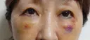 下まぶたの脂肪取り / 脂肪注入（目の下） 湘南美容クリニック 千葉センシティ院 DAY 4 サムネイル用