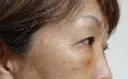 下まぶたの脂肪取り / 脂肪注入（目の下） 湘南美容クリニック 千葉センシティ院 DAY 4 サムネイル用