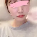 骨削り（頬） FROM B整形外科 (旧バウム整形外科) DAY 30 サムネイル用
