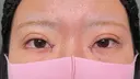 二重埋没 / 目頭切開 HAAB×DREAM BEAUTY CLINIC 大阪梅田院 DAY 0 サムネイル用