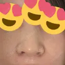 小鼻縮小（切開） アネシス美容クリニック DAY 6 サムネイル用