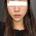糸リフト / 脂肪吸引（顔） / ボトックス（あご） / ヒアルロン酸注入（あご） Tokyo Tensei Clinic 新宿院 DAY 0 サムネイル用