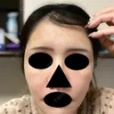 ヒアルロン酸注入（頬） / ヒアルロン酸注入（こめかみ） 仙台N美容クリニック DAY 1 サムネイル用