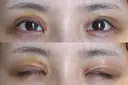 二重切開 / 眼瞼下垂（切開） / スレッドノーズ / ヒアルロン酸注入（鼻翼基部） オーキッド美容クリニック東京御徒町 DAY 160 サムネイル用