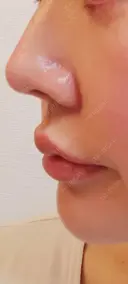 ヒアルロン酸注入（涙袋） / ヒアルロン酸注入（唇） 共立美容外科 梅田院 DAY 1 サムネイル用