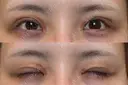 二重切開 / 眼瞼下垂（切開） / スレッドノーズ / ヒアルロン酸注入（鼻翼基部） オーキッド美容クリニック東京御徒町 DAY 161 サムネイル用