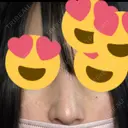 小鼻縮小（切開） アネシス美容クリニック DAY 11 サムネイル用