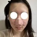 鼻尖形成（切開） / 軟骨移植 / 鼻柱下降・鼻唇角形成（猫手術） 東京美専クリニック DAY 0 サムネイル用