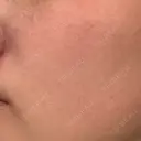 ピーリング（ニキビ・毛穴） エルーラクリニック DAY 0 サムネイル用