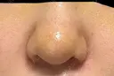 隆鼻術 / 鼻尖形成（切開） / 鼻中隔延長（切開） / 軟骨移植 / 鼻孔縁挙上 / 鼻翼基部形成（貴族手術） / 鼻柱下降・鼻唇角形成（猫手術） 4Dクリニック DAY 7 サムネイル用